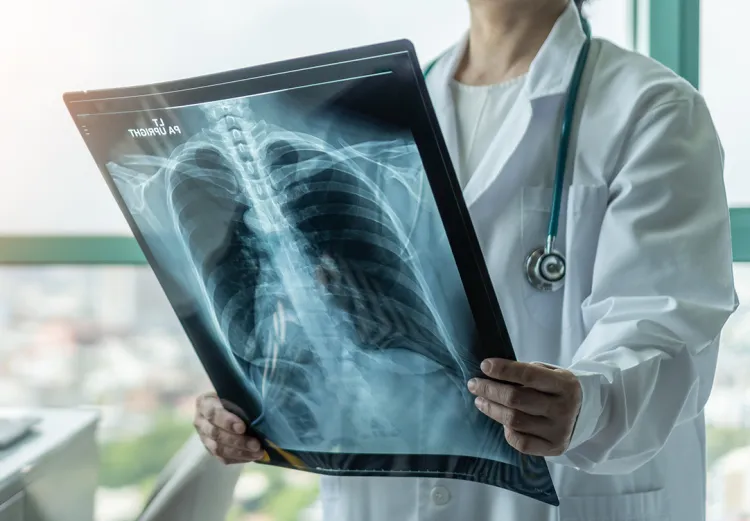 Diagnóstico tardio reduz chances de cura para o câncer de pulmão no Brasil